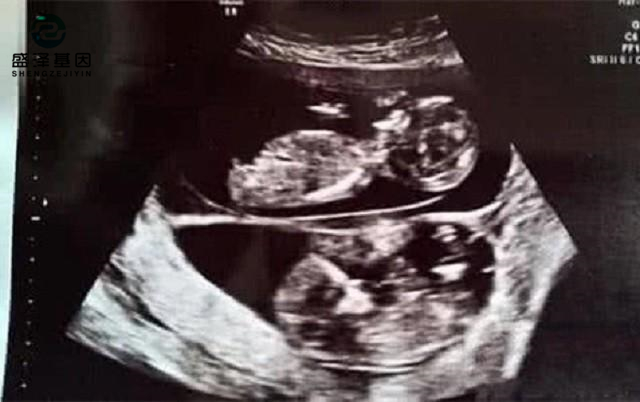 親子鑒定師講述:老公明明是無精癥,老婆卻試管嬰兒懷孕成功? 親子鑒定師講述:老公明明是無精癥,老婆卻試管嬰兒懷孕成功?