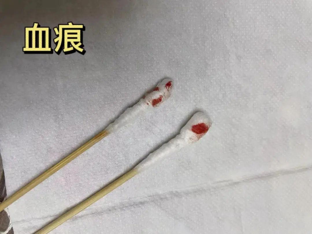 親子鑒定樣本采集棉棒上的血痕可以嗎? 親子鑒定樣本采集棉棒上的血痕可以嗎?