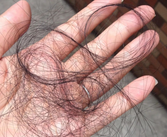 掉落的毛囊毛發(fā)可以拿去做染色體親子鑒定嗎？