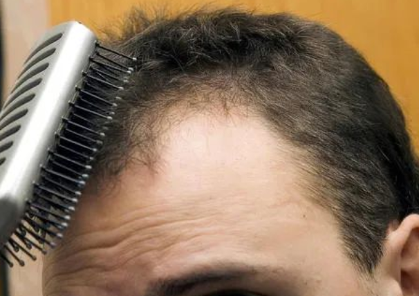 毛發可以做親子鑒定檢材嗎，怎么采集樣本才可以？